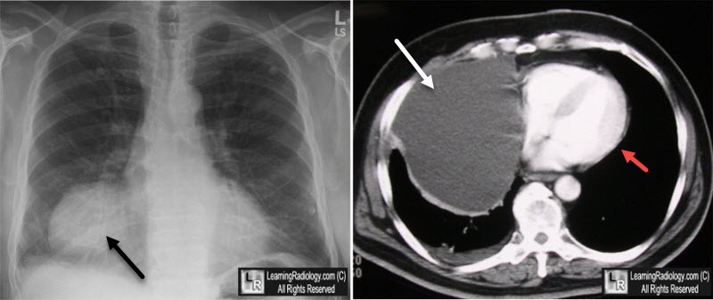 Pericardial Cyst